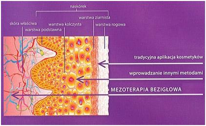 mezoterapia bezigłowa - fot. 2