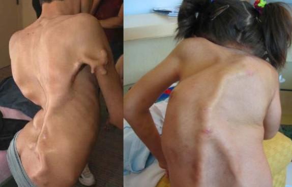 Fibrodysplasia-Ossificans-Progressiva-Pictures-2