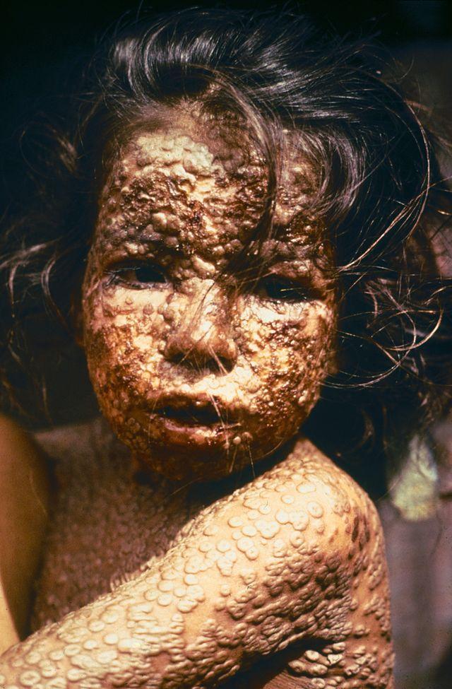 640px-Child_with_Smallpox_Bangladesh