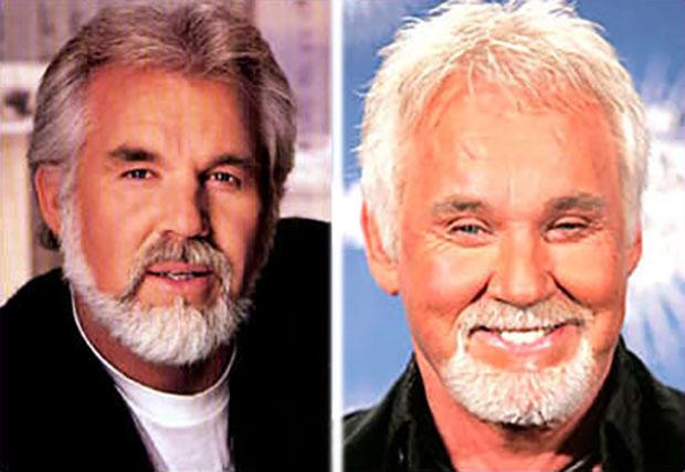 Kenny-Rogers-Plastic-Surgery