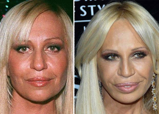 donatella-versace-plastic