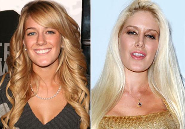 heidi-montag-plastic-surgery2