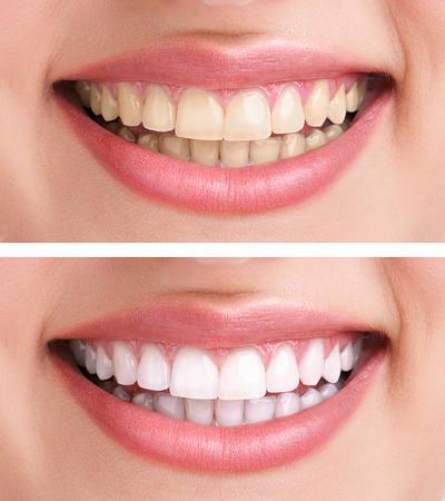 whiten-teeth-2opt