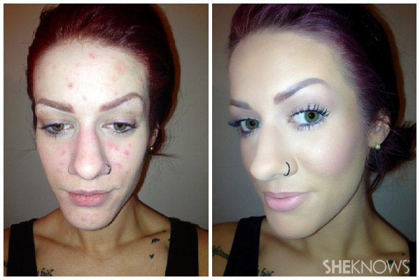 Clear-skin-before-and-after-collage