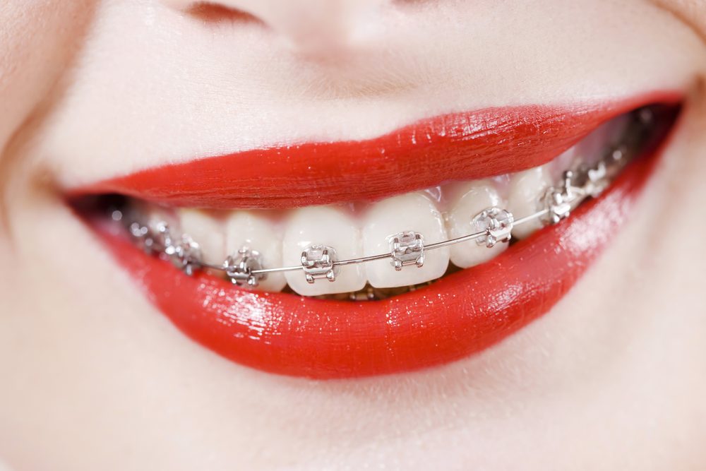 Close-up beautiful smile of atractive woman wearing dental braces.