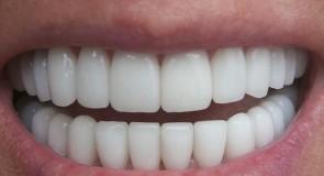 Trochę informacji o implancie zęba