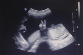 USG w czasie ciąży – zobacz niesamowite zdjęcia!