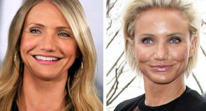 10 nieudanych operacji plastycznych gwiazd! Przerażające zdjęcia przed i po!