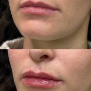 Medycyna estetyczna bez przerysowania. Te zabiegi są uznawane za najbezpieczniejsze przez lekarzy