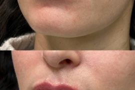 Medycyna estetyczna bez przerysowania. Te zabiegi są uznawane za najbezpieczniejsze przez lekarzy