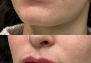 Medycyna estetyczna bez przerysowania. Te zabiegi są uznawane za najbezpieczniejsze przez lekarzy