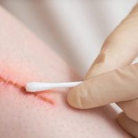 gojenie rany po operacji plastycznej objawy po zabiegu